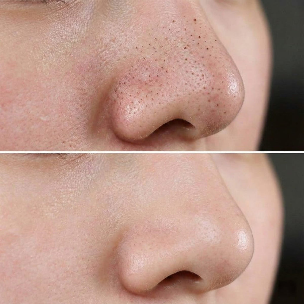 Aparat profesional curatare faciala cu vacuum pentru puncte negre, ingrijire ten, curatare profunda si masaj facial 2