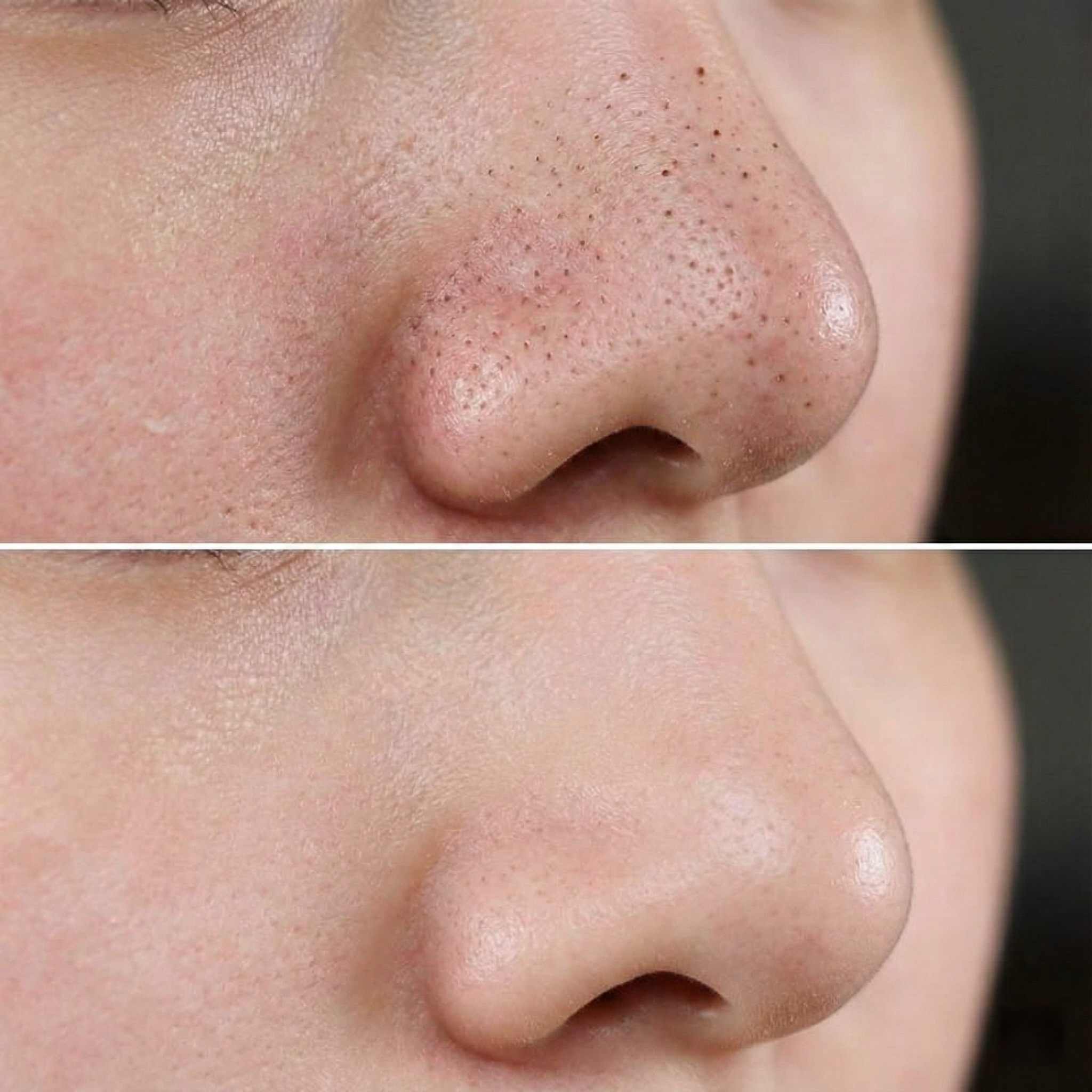 Aparat profesional curatare faciala cu vacuum pentru puncte negre, ingrijire ten, curatare profunda si masaj facial